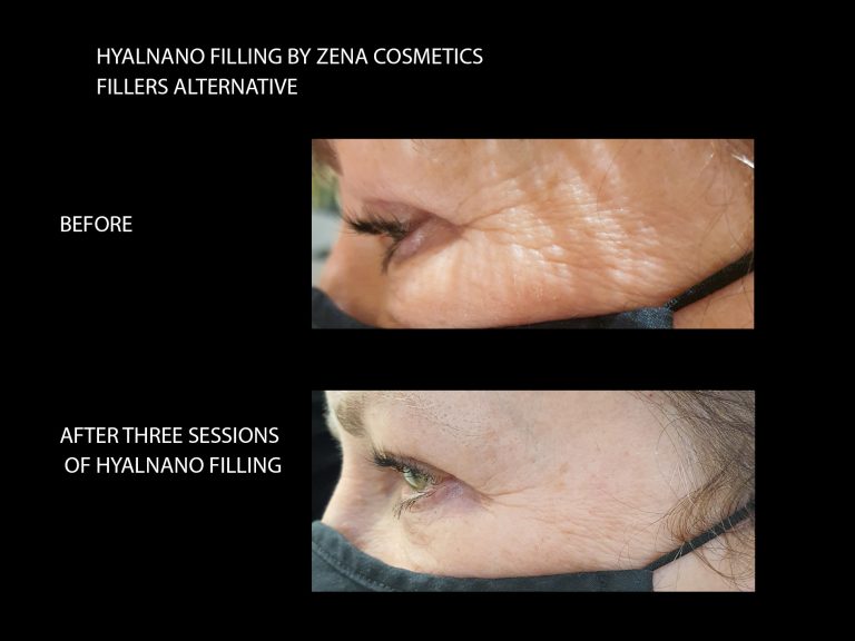 hyalnano filling before and after eye are result